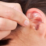 Acupuncture Ear Staple